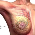 breast cancer