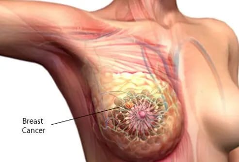 About breast cancer
